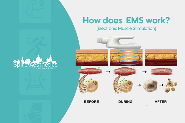 EMS treatment for post pregnancy weight loss treatment Northwood
