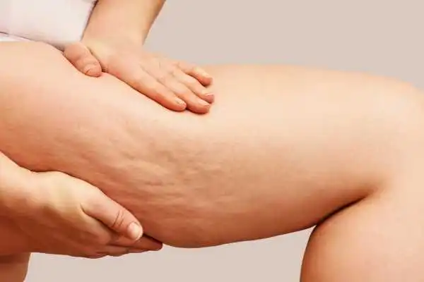Image of woman showing leg with cellulite Northwood