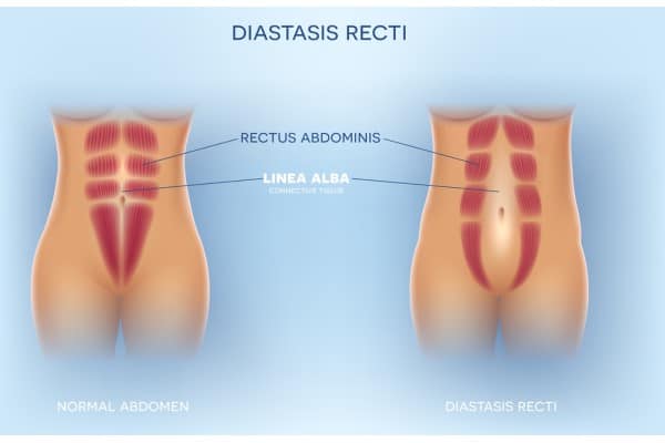 What Non-Surgical Options Are Available for Diastasis Recti Northwood?