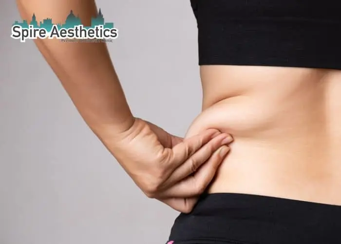 Image of woman pinching fat on their hips Northwood. Fat Freezing treatment