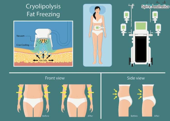 Image of diet and fat freezing combined for best results for Spire Aesthetics Northwood