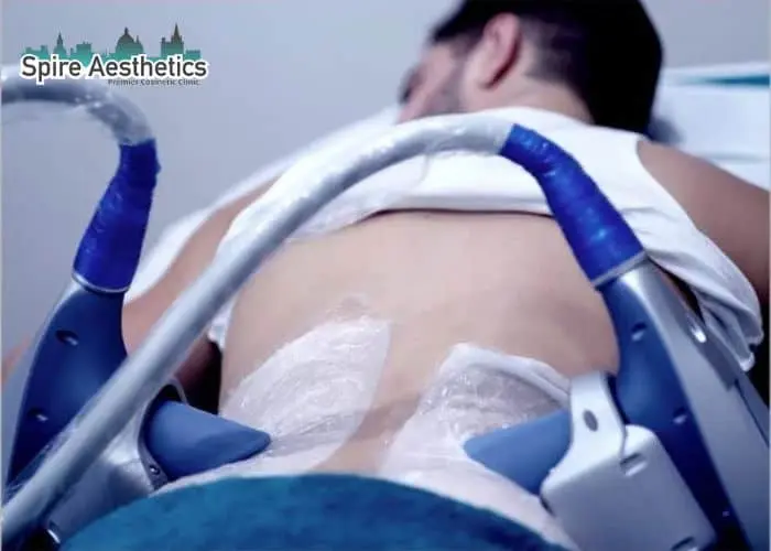 Man having fat freezing treatment done on love handles before a competitions Northwood to create a sculpted look.