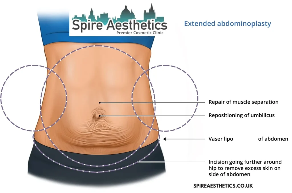 Understanding Loose Skin After Gastric Band Northwood Surgery and HIFU Treatment