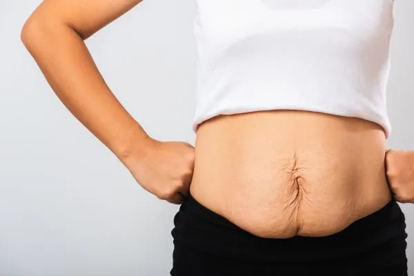 Image of a woman's stomach after weight loss with sagging skin following a gastric band Northwood