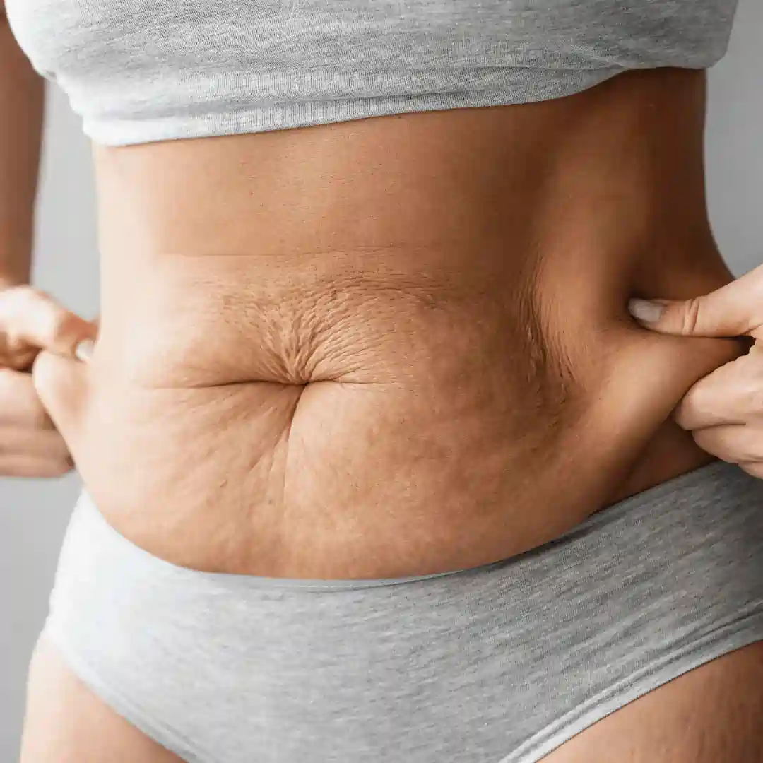 Is It Normal to Have Loose Skin After Pregnancy Northwood?