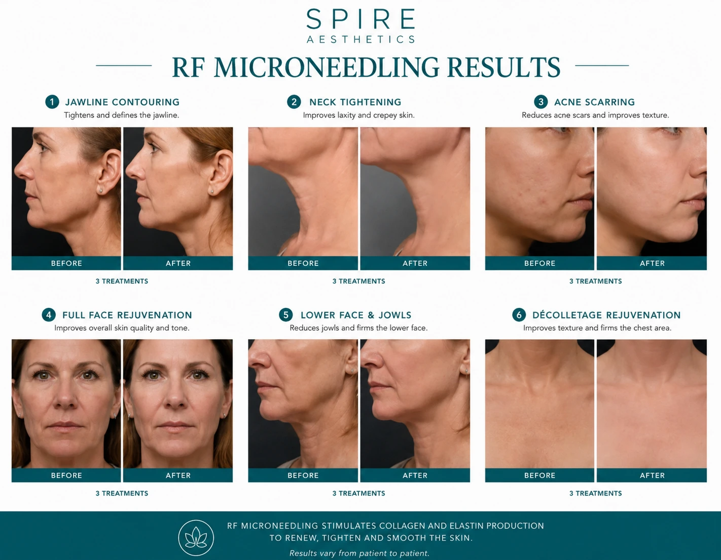 RF Microneedling Skin tightening Northwood results