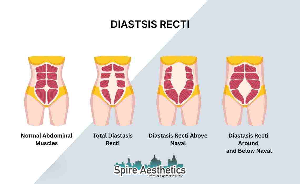 Is Non-Surgical Diastasis Recti Treatment Right for You? Common Concerns Answered Northwood